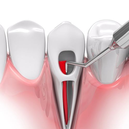 an illustration of the root canal therapy process