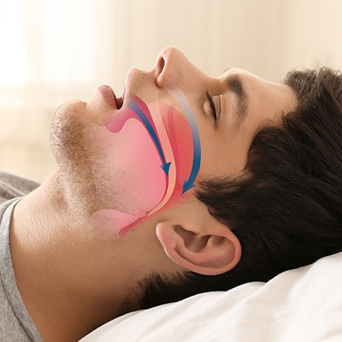 Man with animated airway over his cheek