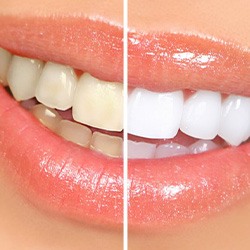 Before and after teeth whitening