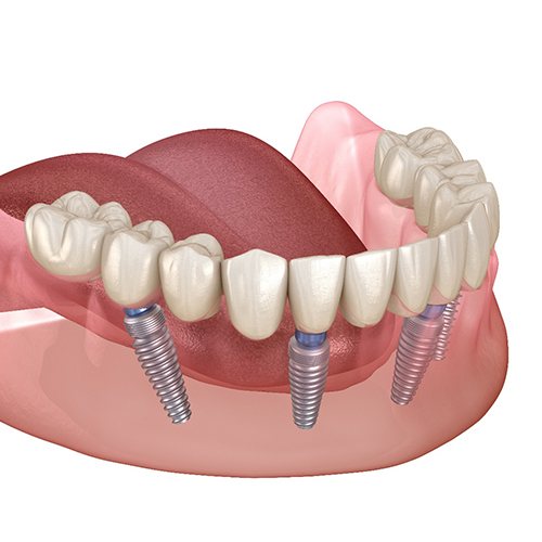 Illustration of mouth with All-on-4 in Minot, MD