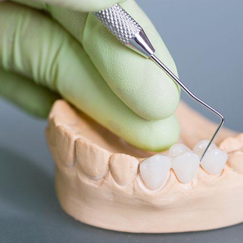 A dental bridge seated on a mouth mold