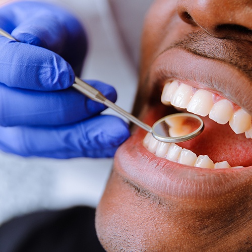 Closeup of dentist examining smile with tooth colored filling