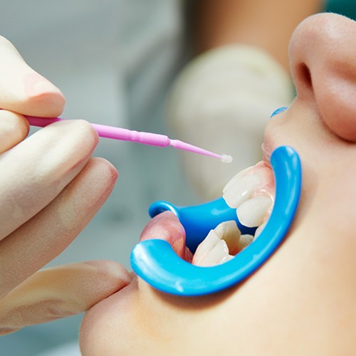 Child receiving silver diamine fluoride treatment