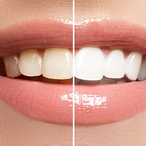 Smile before and after teeth whitening