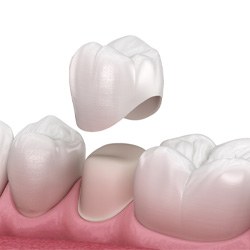 Illustration of a dental crown in Minot, ND for lower arch