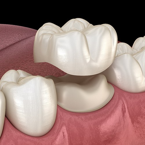 Illustration of a dental crown in Minot, ND