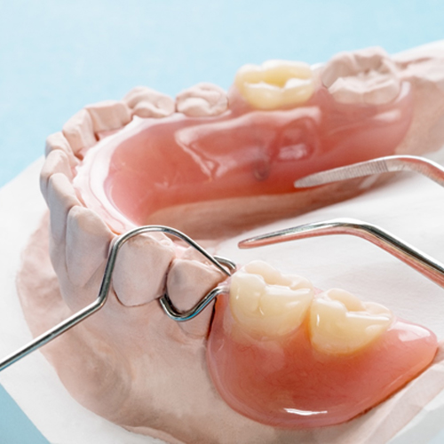 a plaster model of a mouth with a partial denture on it