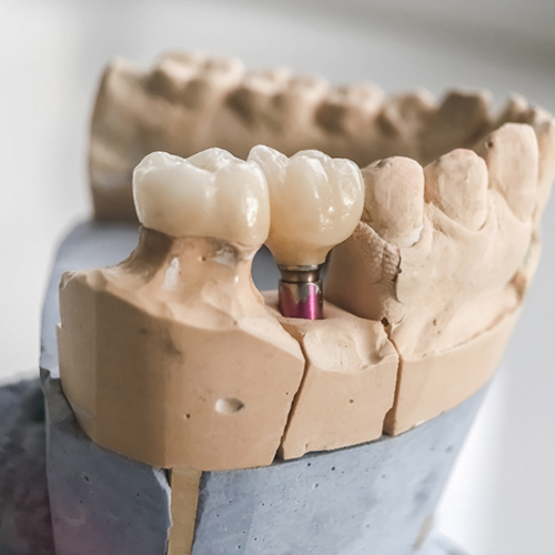 a model of a mouth with a dental implant holding a crown