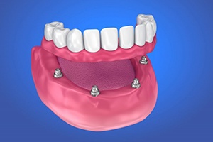 four dental implants supporting a full denture 