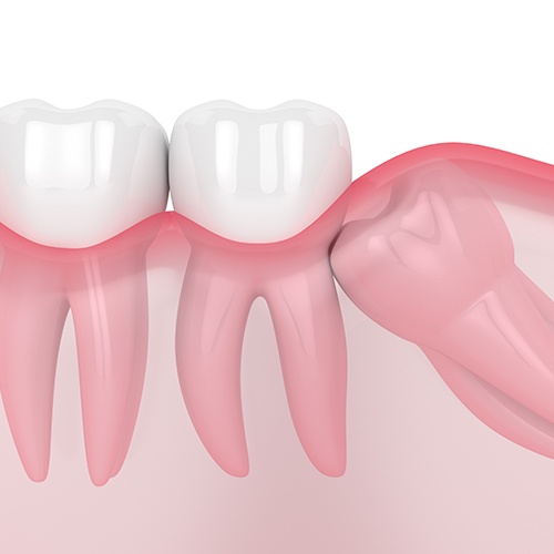 Animated smile with impacted tooth