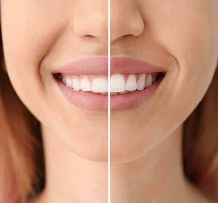 A woman before and after gum recontouring