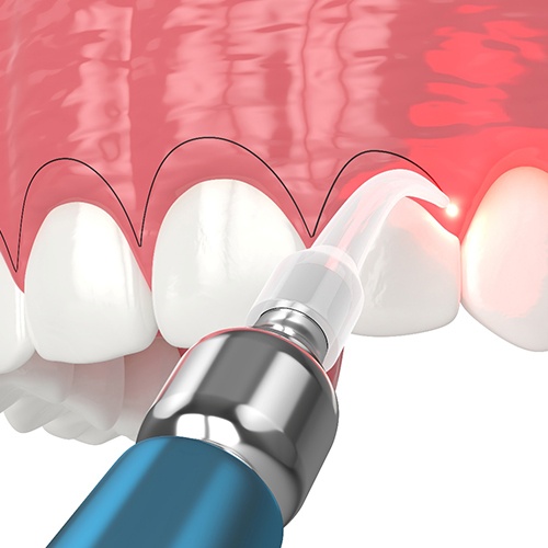A CGI of a gum recontouring procedure