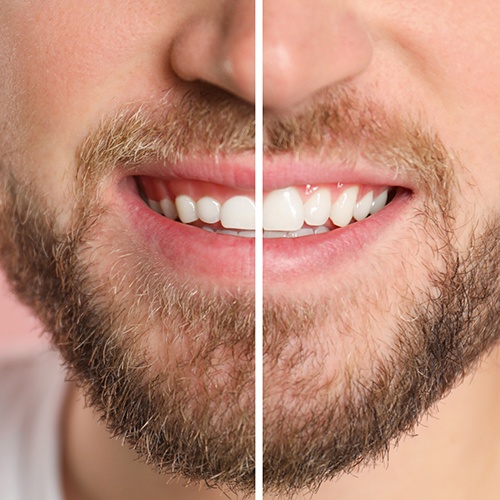 A man’s smile before and after gum recontouring