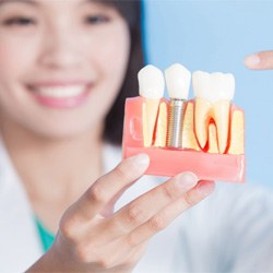 A dental implant in Minot  