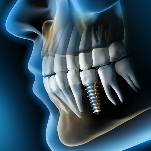 Animated dental implant supported dental crown