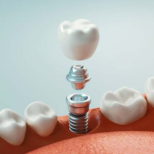 dental implant with abutment and crown