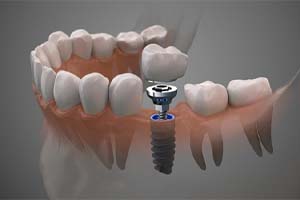 single dental implant with crown
