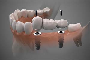 two dental implants with bridge