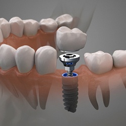 single dental implant with a crown