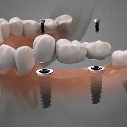 two dental implants with a bridge