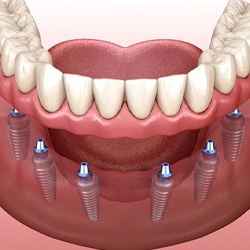 six dental implants with a full denture