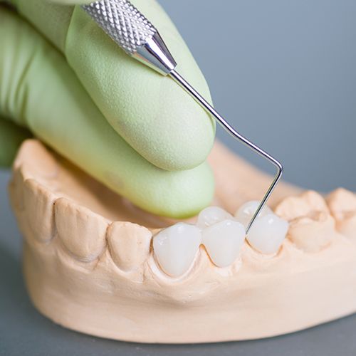 Model smile with dental bridge restoration