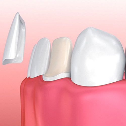 model of veneer being placed over bottom tooth 