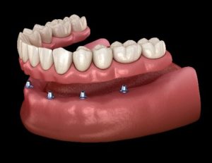 Digital model of All-On-4 lower denture
