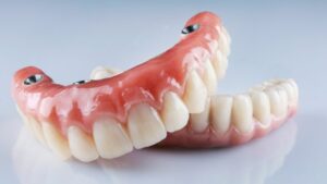 Image of implant dentures on a table