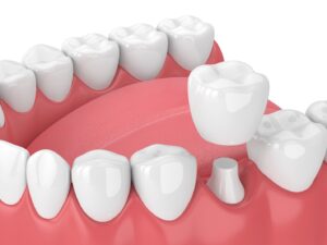 Digital rendering of crown about to be fitted over reshaped tooth.